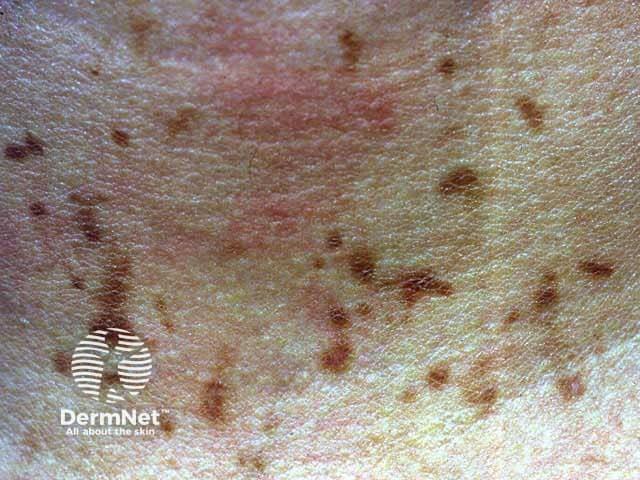 String trimmers dermatitis