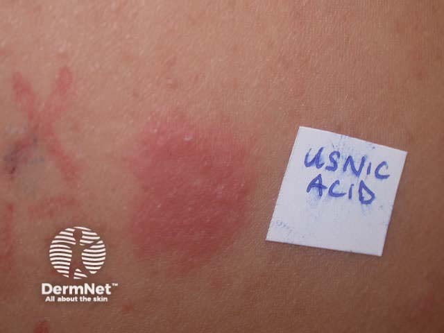 Patch test allergy to usnic acid