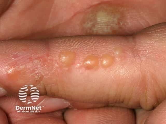 Vesicles and blisters on the fingers in vesicular eczema