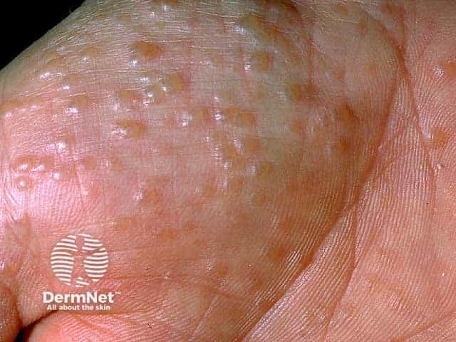 Discrete vesicles and blisters on the palmar skin