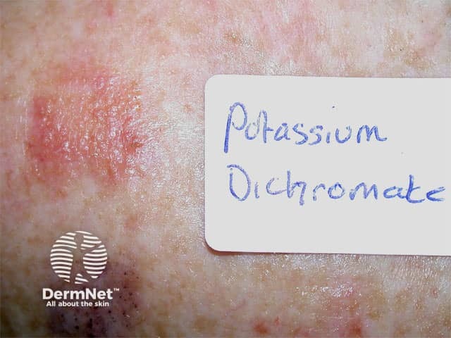 Positive patch test to potassium dichromate