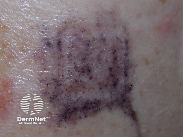 PPD negative patch test