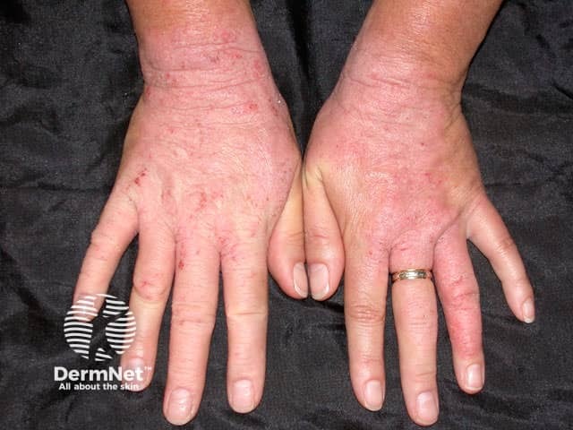 Rubber dermatitis