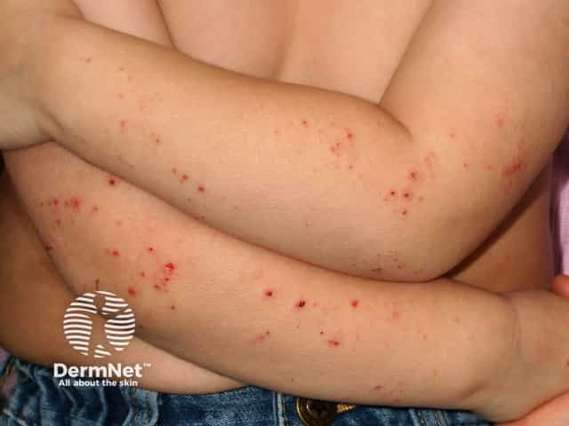 Pruritic atopic dermatitis