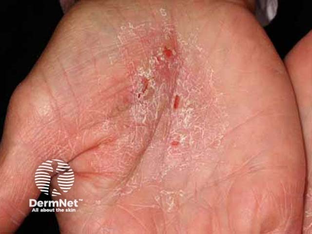 Chronic hand dermatitis