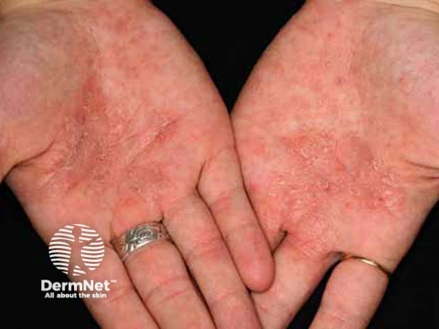 Chronic hand dermatitis