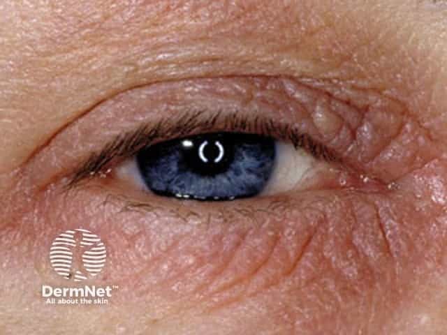 Eyelid contact dermatitis