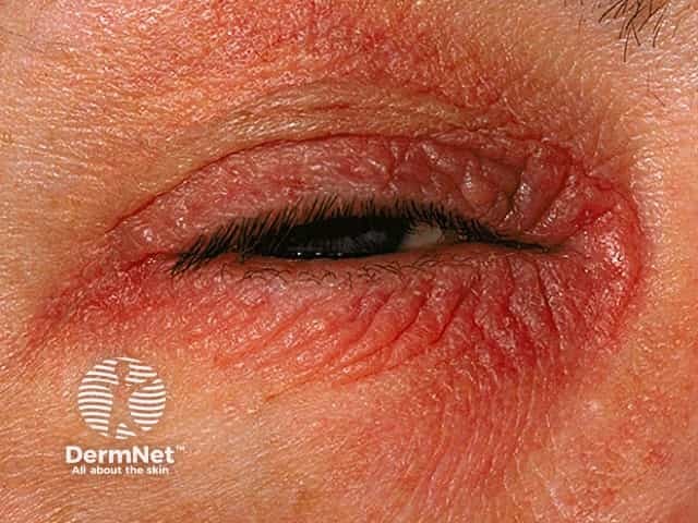 Eyelid contact dermatitis