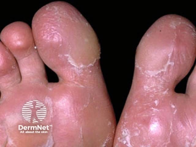 Juvenile plantar dermatosis