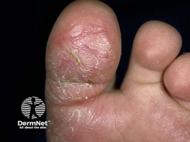 Juvenile plantar dermatosis