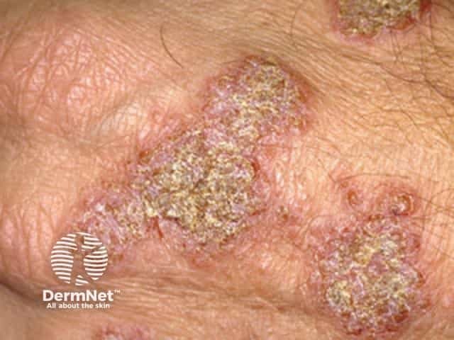 Discoid eczema