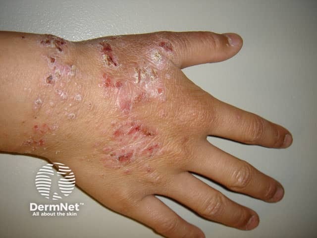 Atopic hand dermatitis