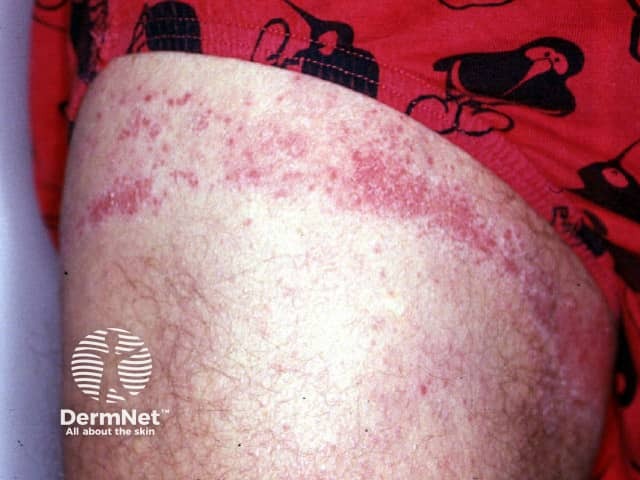 Rubber dermatitis