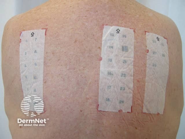 Baseline series of patch test allergens