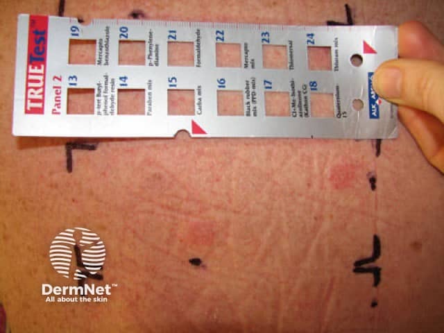 Baseline series of patch test allergens