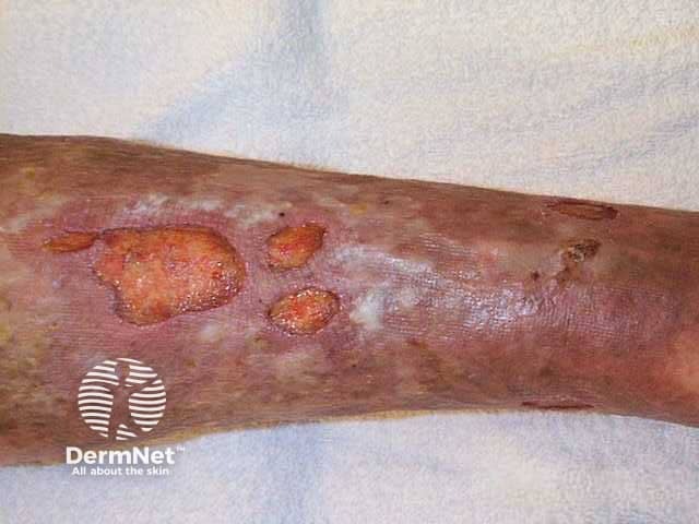 Venous ulcer