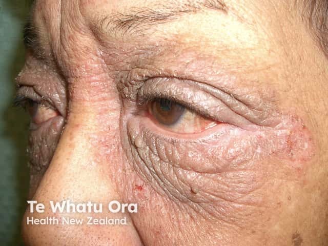 Severe chronic eyelid dermatitis