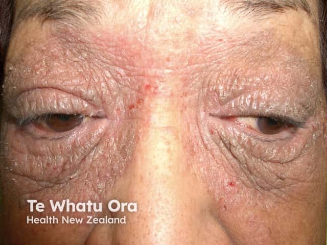 Eyelid contact dermatitis