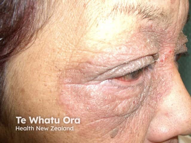 Eyelid contact dermatitis