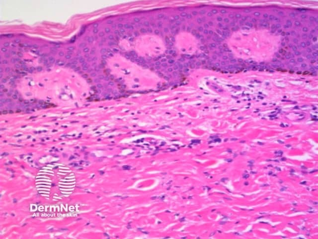 Dermatofibroma pathology