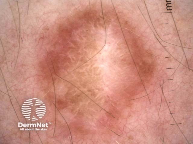 Dermatofibroma dermoscopy