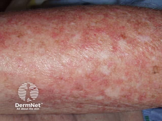 Dermatomyositis of the arm