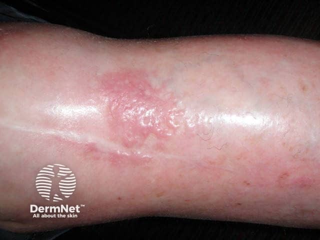 Dermatomyositis of the arm