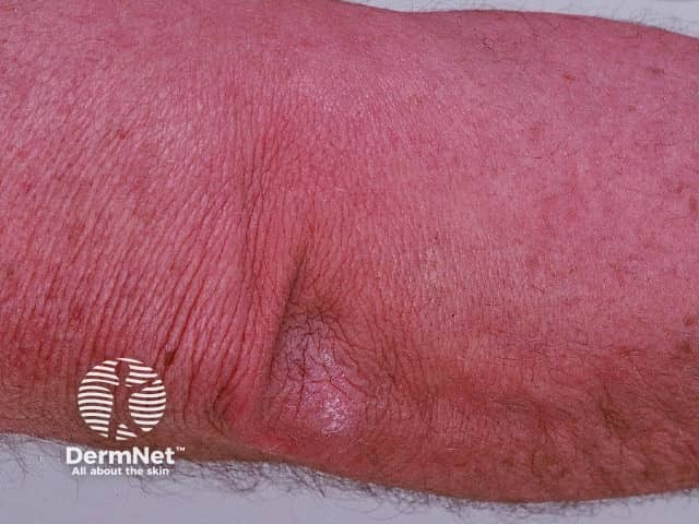 Dermatomyositis of the arm