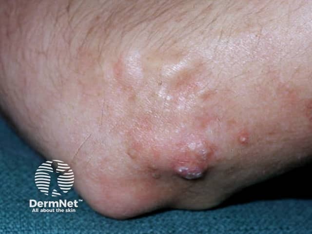 Dermatomyositis