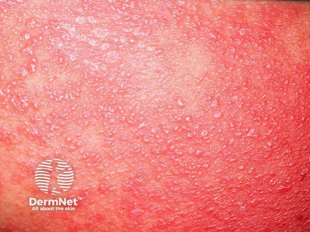 Photosensitive rash on the V of chest