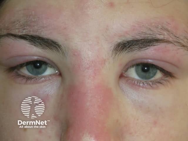 Dermatomyositis of eyelids