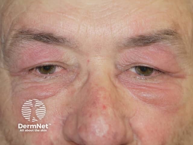 Dermatomyositis of eyelids