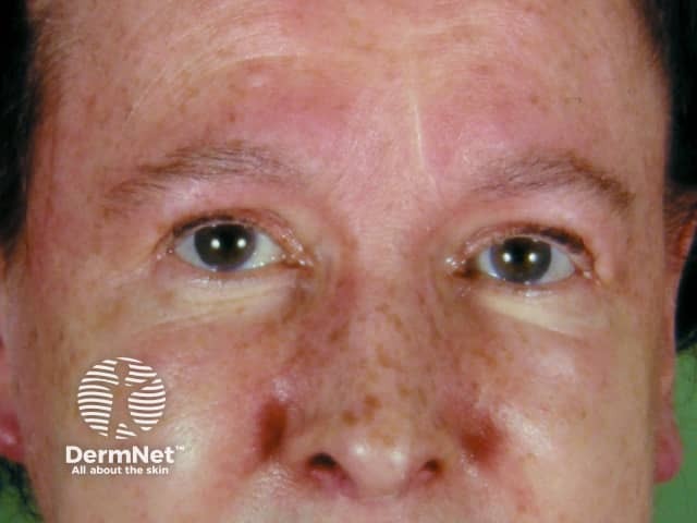 Dermatomyositis of eyelids