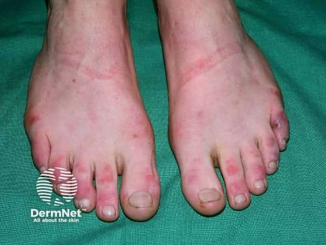 Dermatomyositis of the foot