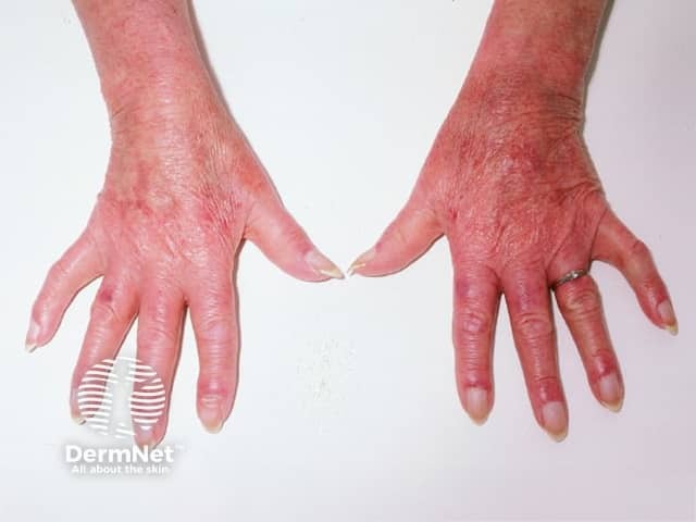 Dermatomyositis of the hand