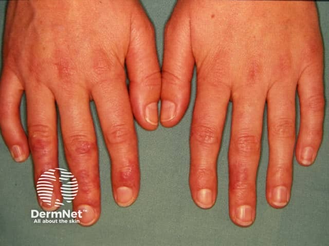 Dermatomyositis of the hand