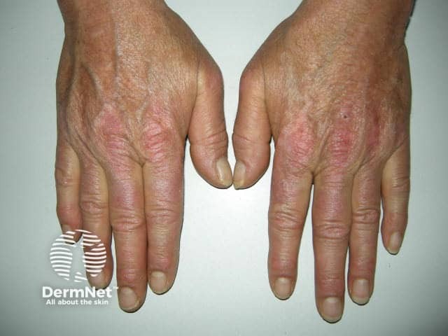 Dermatomyositis of the hand