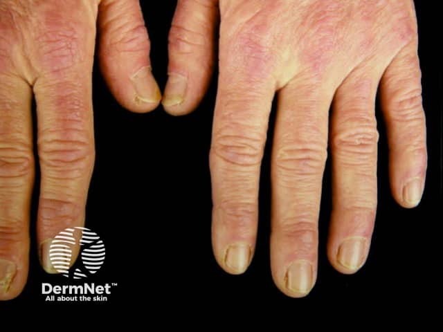 Dermatomyositis of the hand