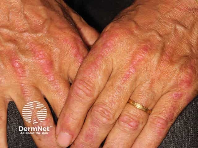 Dermatomyositis of the hand