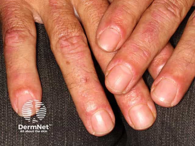 Dermatomyositis of the hand