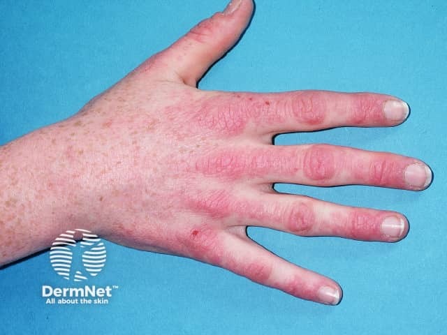 Dermatomyositis of the hand