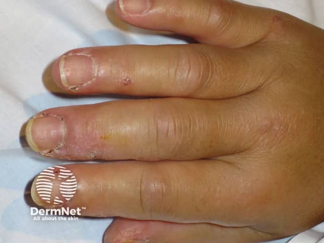 Dermatomyositis of the hand