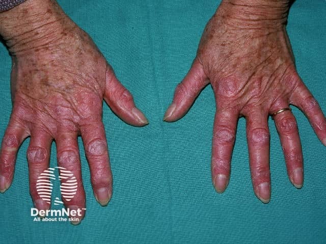 Dermatomyositis of the hand