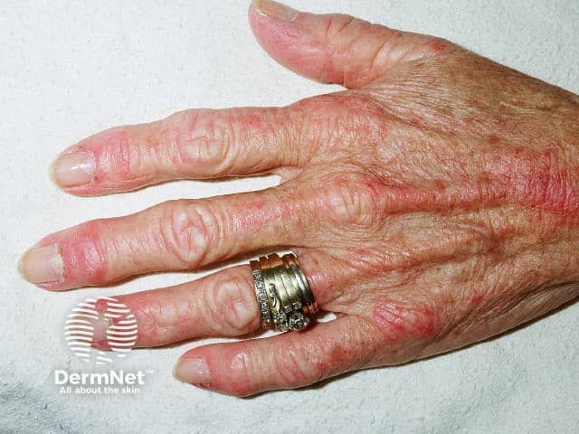 Dermatomyositis of the hand