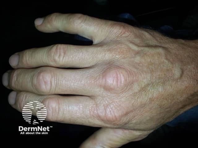 Dermatomyositis of the hand