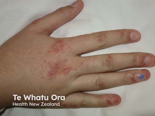 Gottron papules over joints