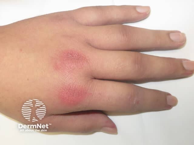 Dermatomyositis of the hand