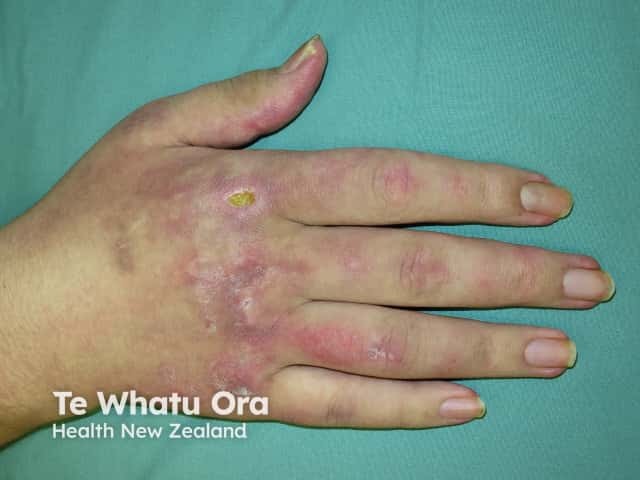 Dermatomyositis of the hand