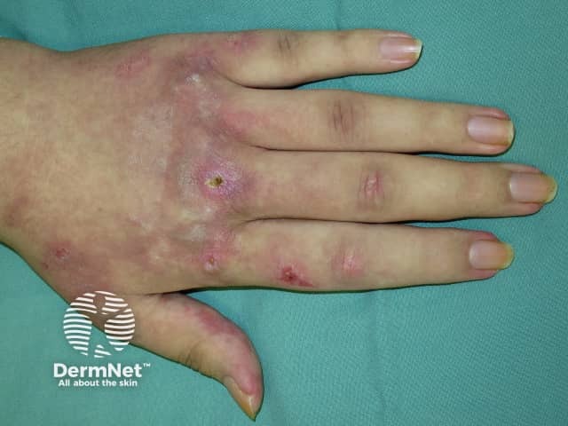 Dermatomyositis of the hand