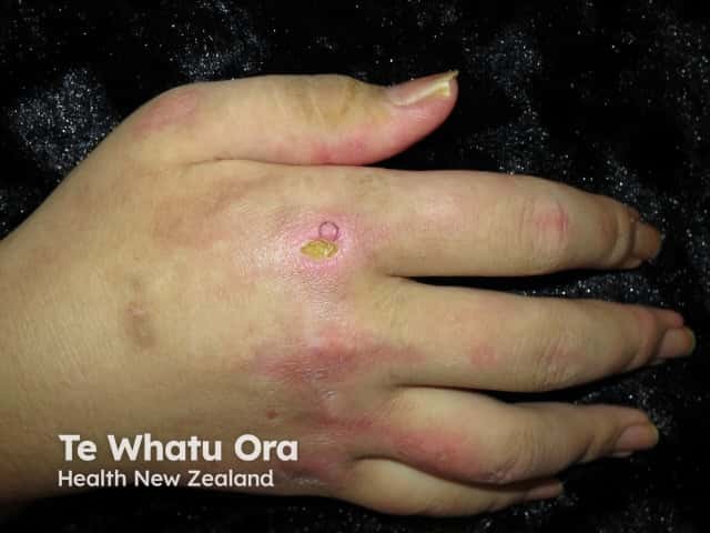 Dermatomyositis of the hand